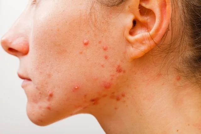 tipos-de-acne_40834_l