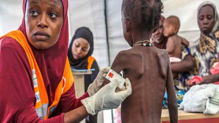 ninos_desnutridos_Somalia-e1541776589498