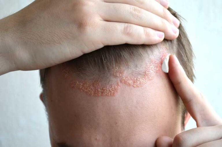 dermatitis-injerto-capilar-768x509