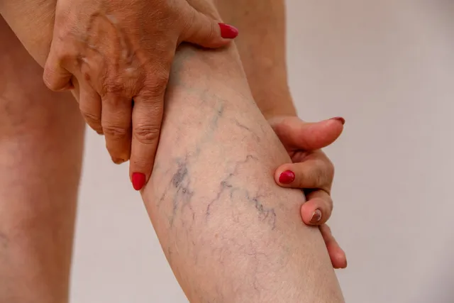 elderly-woman-in-white-panties-shows-cellulite-and-varicose-veins-on-light-isolated-background-640w