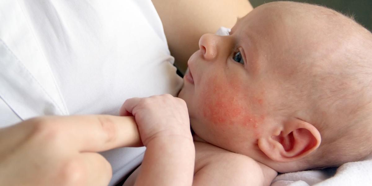 dermatitis.jpg_759710130