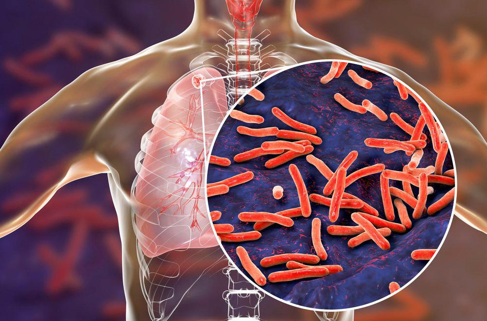 tuberculosis-