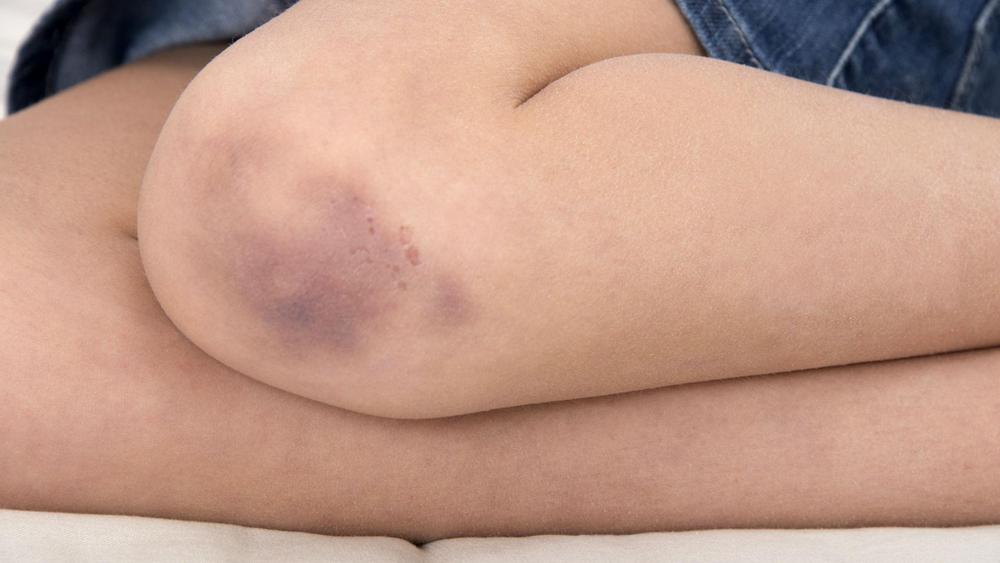 moreton-en-la-pierna