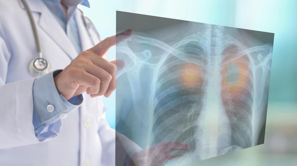 un-estudio-en-ratones-muestra-que-una-terapia-combinada-detiene-la-progresion-de-cancer-de-pulmon-de-celulas-pequenas.r_d.679-369