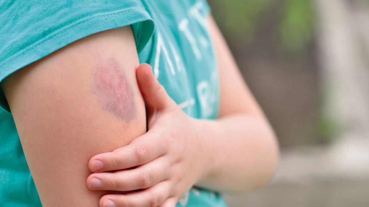 Hematomas-Por-que-aparecen-moretones-en-la-piel