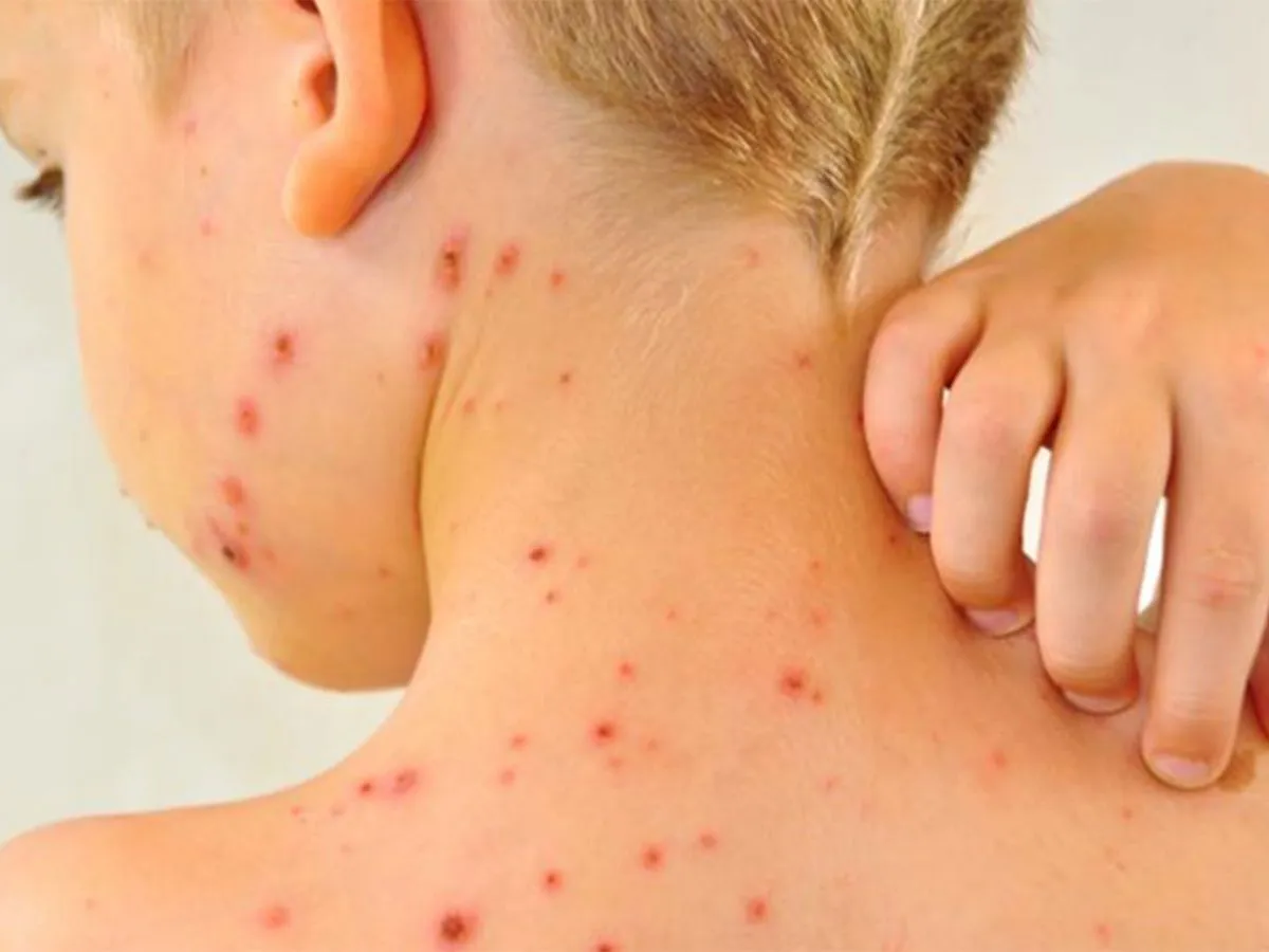 sarampion_ninos.jpg_1902800913