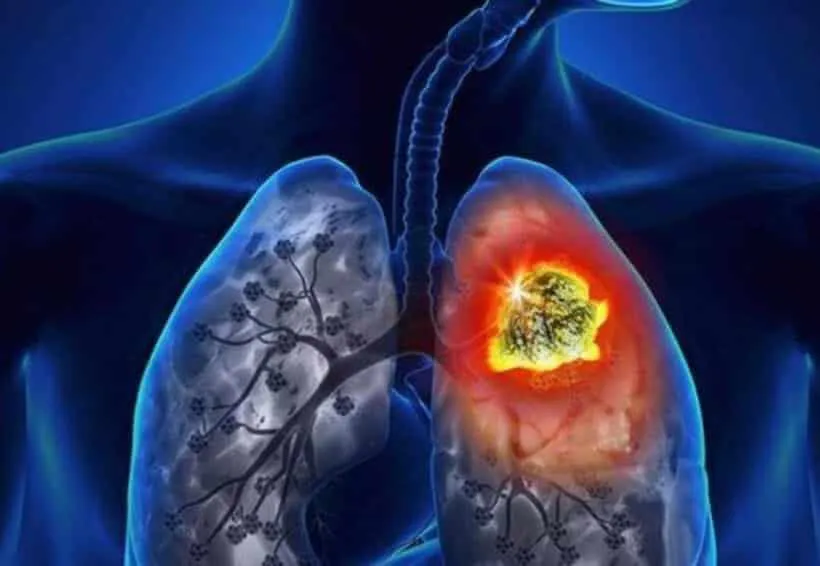 cancer-de-pulmon-17-1-focus-0-0-1200-675