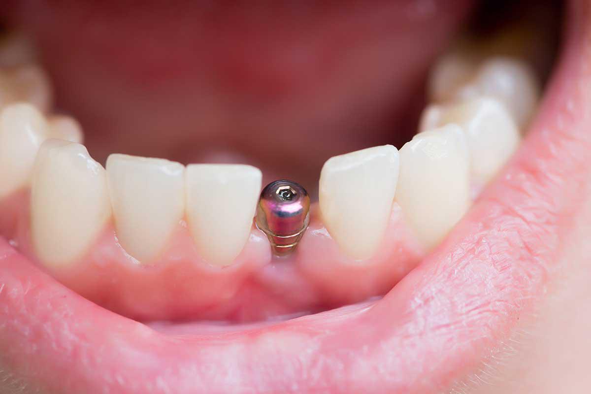 implante-dental-rechazo-clinica-dental-barcelona