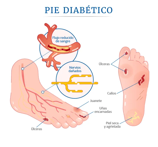 Pie-diabetico