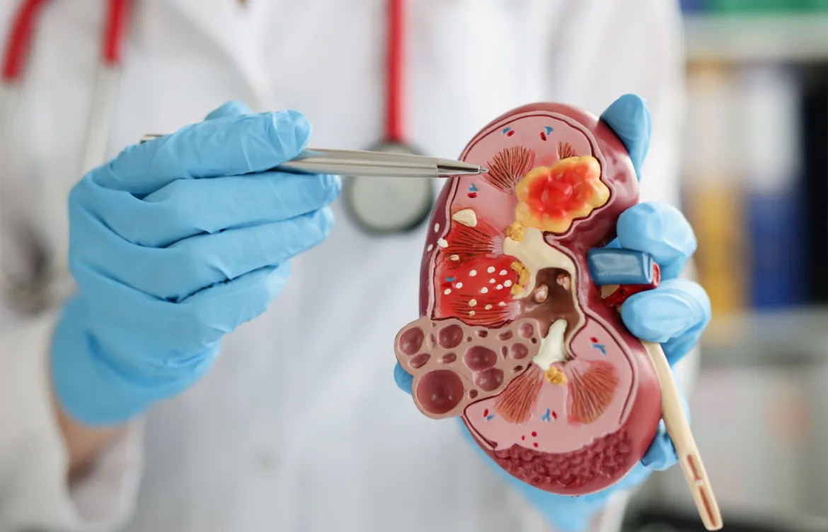 cancer-renal-1170x752