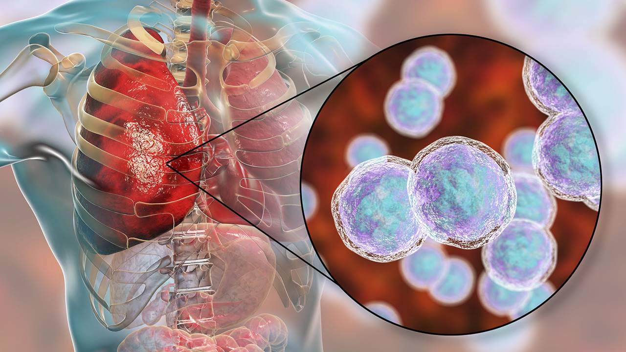 neumonia-ficha_f1171fba_1280x720