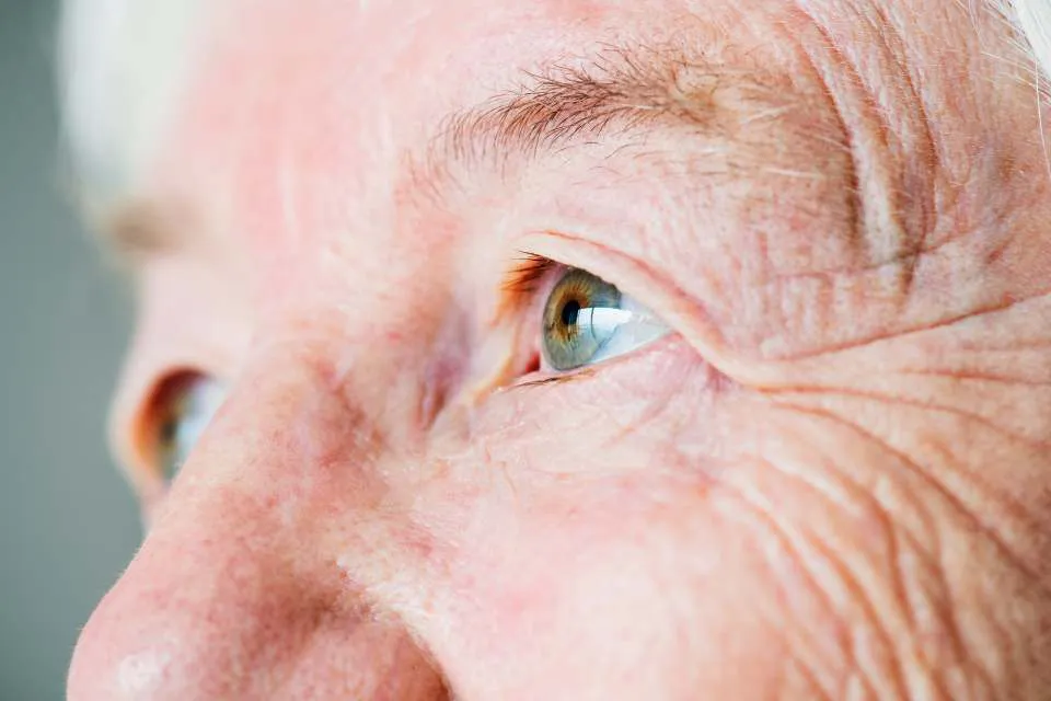 Glaucoma-la-primera-causa-de-ceguera-irreversible-a-nivel-mundial