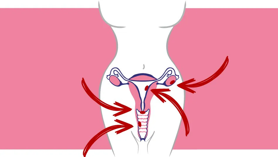 cáncer-ginecológico