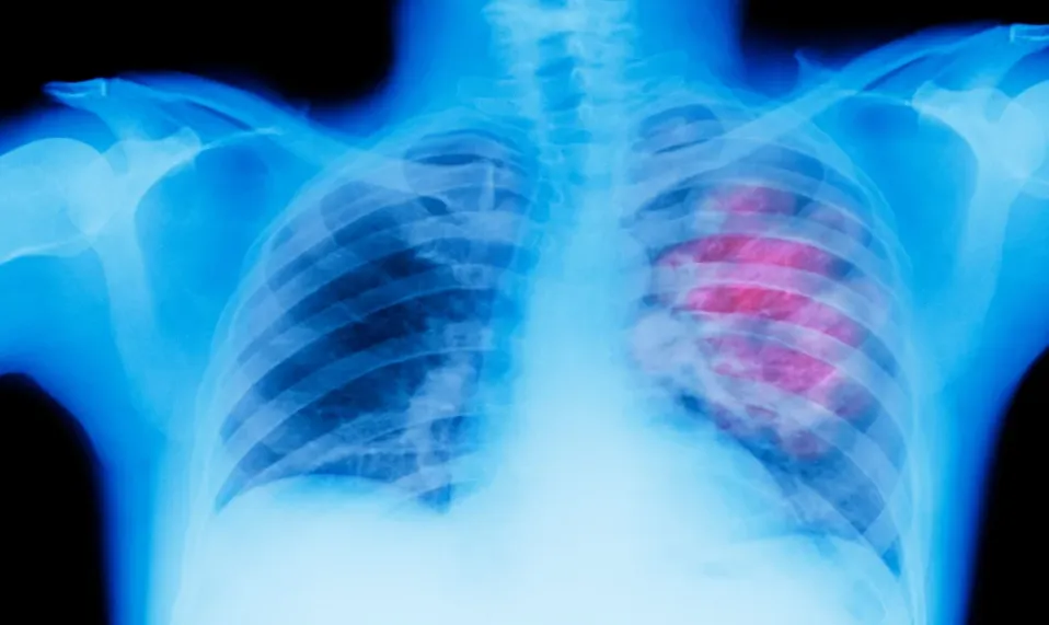 Cancer-de-Pulmon
