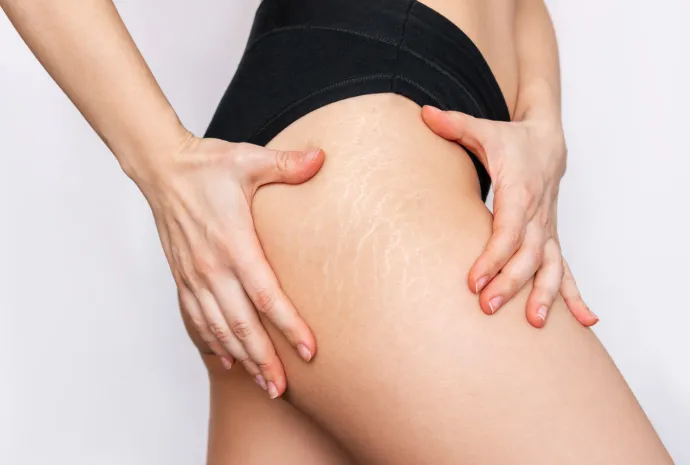 acabar-cicatrices-estrias