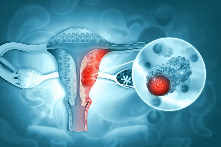 Un-hallazgo-clave-identifico-senales-tempranas-del-cancer-de-ovario-en-las-trompas-de-Falopio