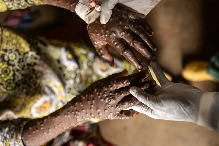mpox-africa