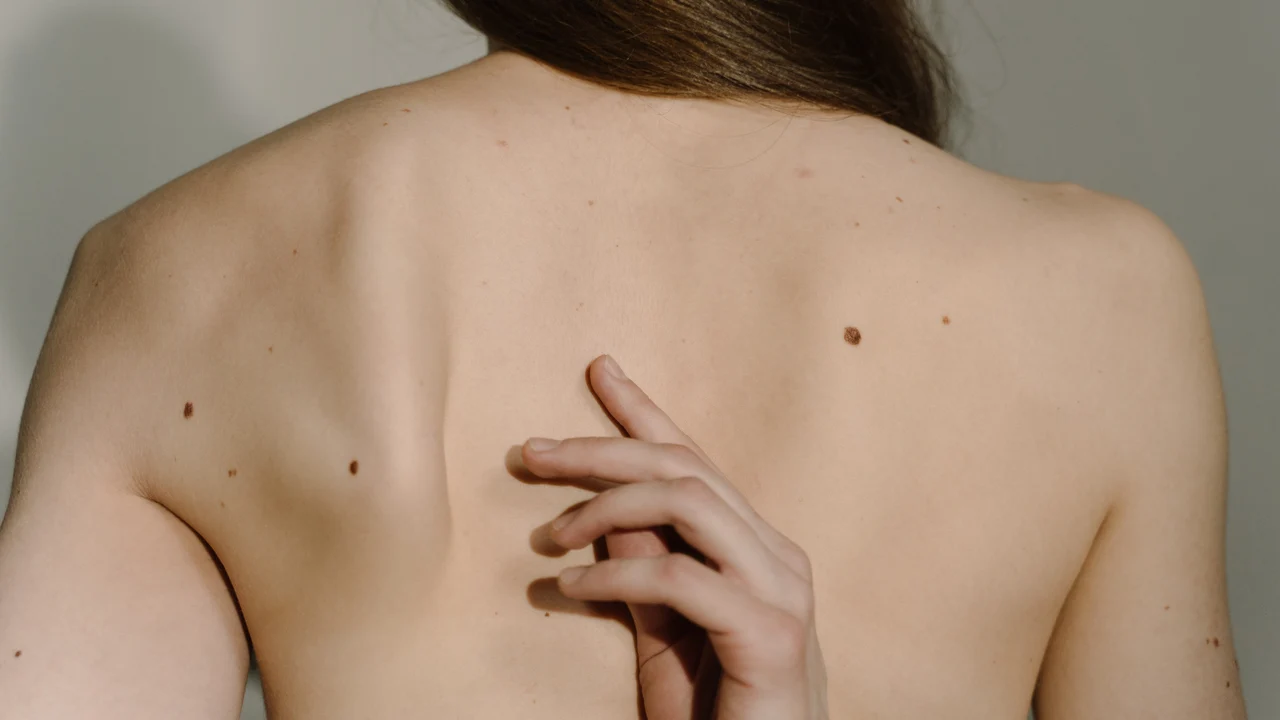 como-revisarse-piel-lunares-prevenir-melanoma_69
