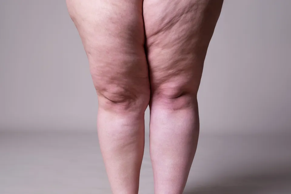 Lipedema-no-es-lo-mismo-que-obesidad-como-diferenciarlas-shutterstock_1626327589