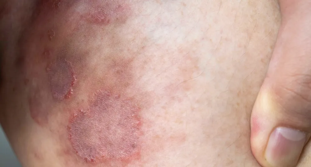 tlmd-tinea