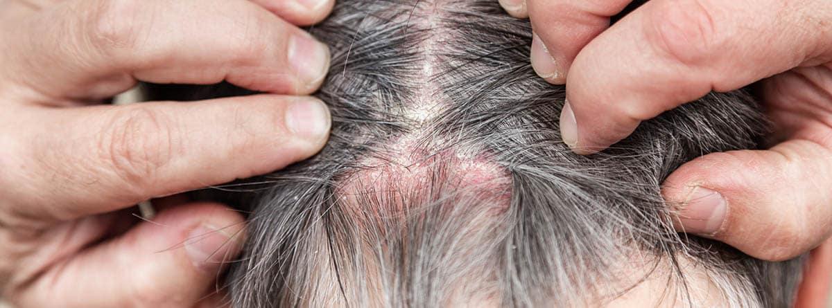 cuero-cabelludo