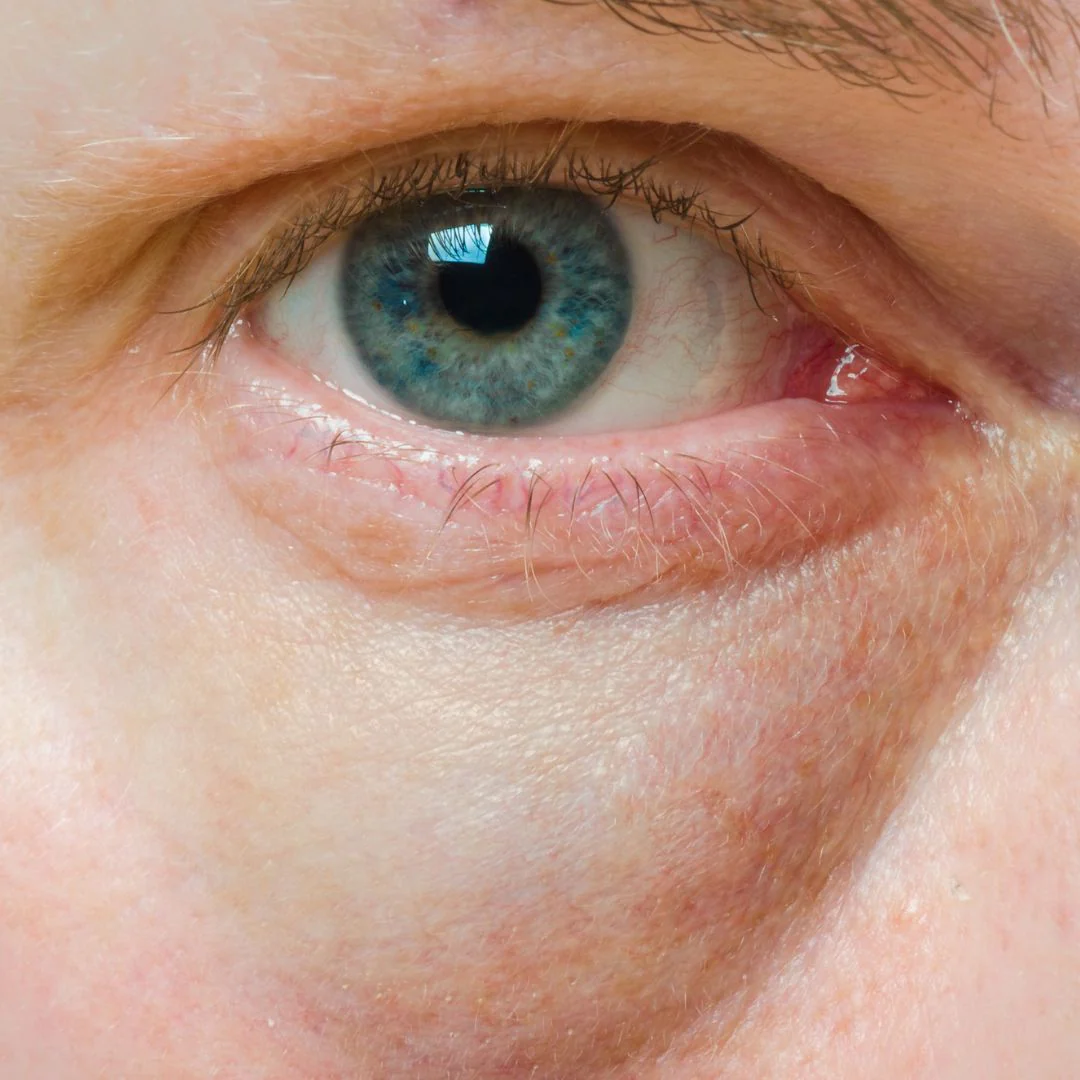 5_Trucos_para_eliminar_las_bolsas_de_los_ojos_y_las_ojeras