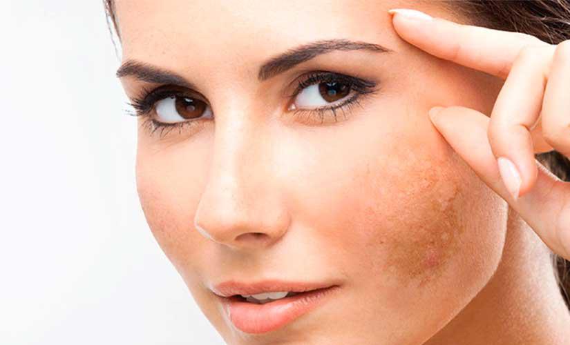 melasma-post