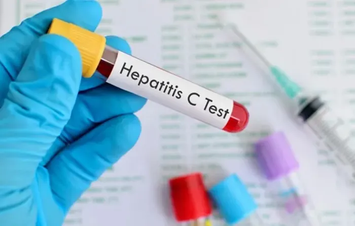 hepatitis
