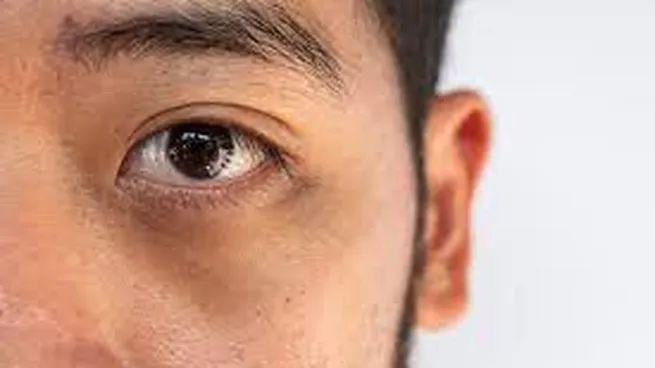 ojeras-chicojpg