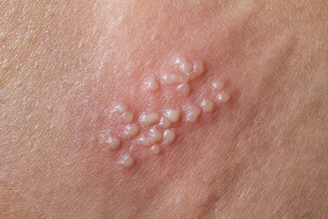 sintomas-del-herpes-genital_60563_l