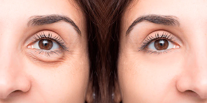 Blog-Ojeras-min