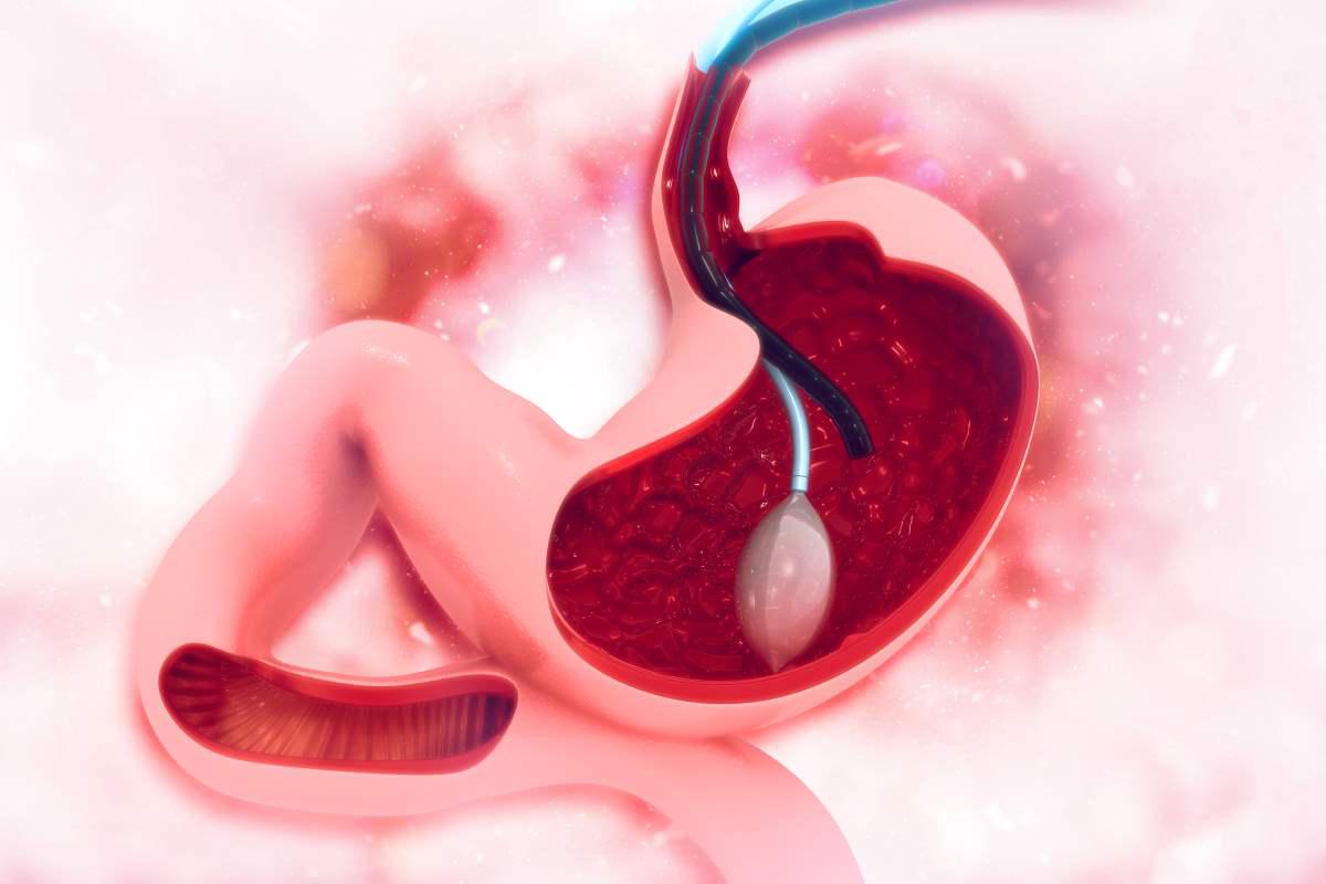 balon-gastrico-pros-y-contras