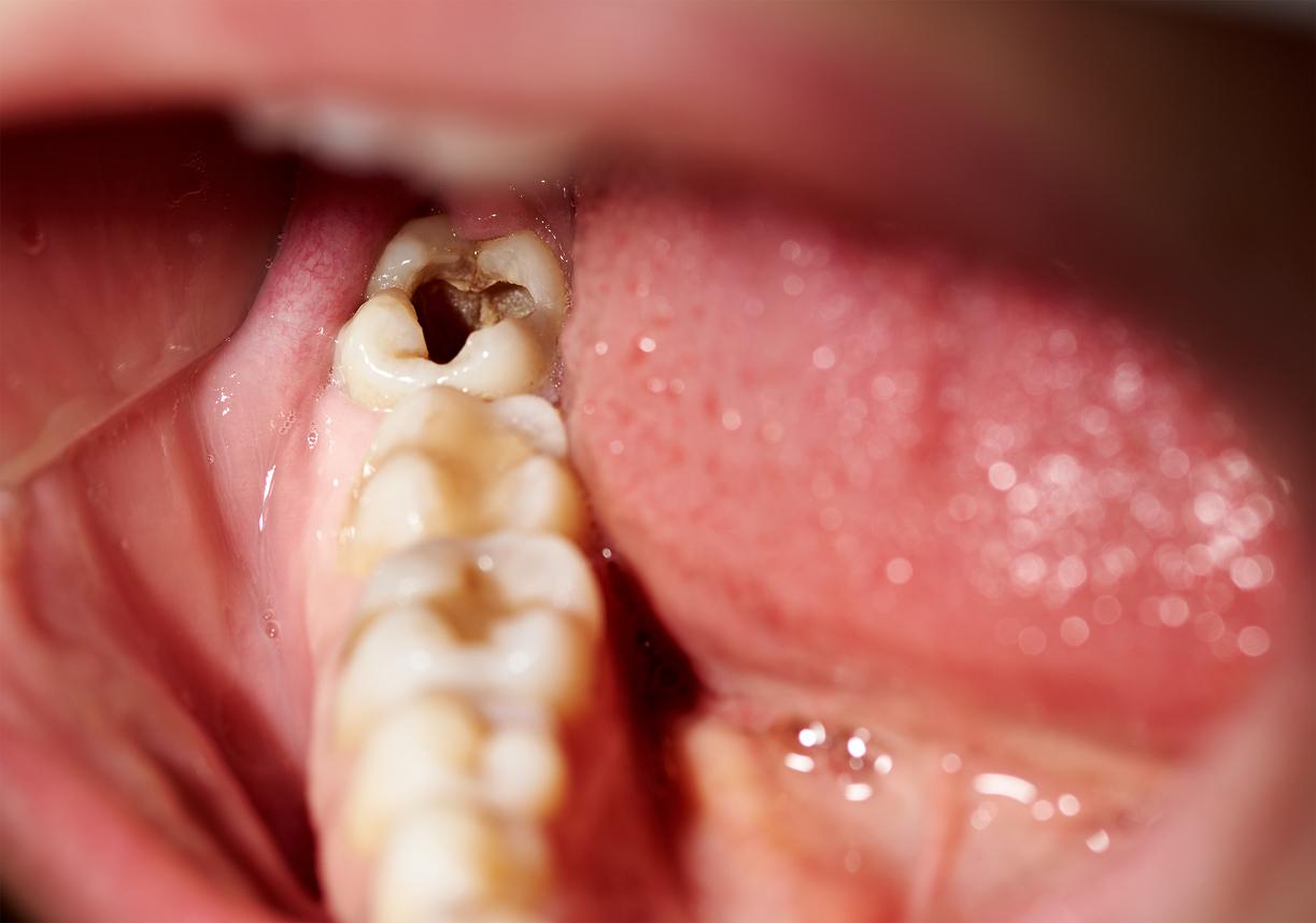 las_personas_mas_propensas_a_tener_caries_son