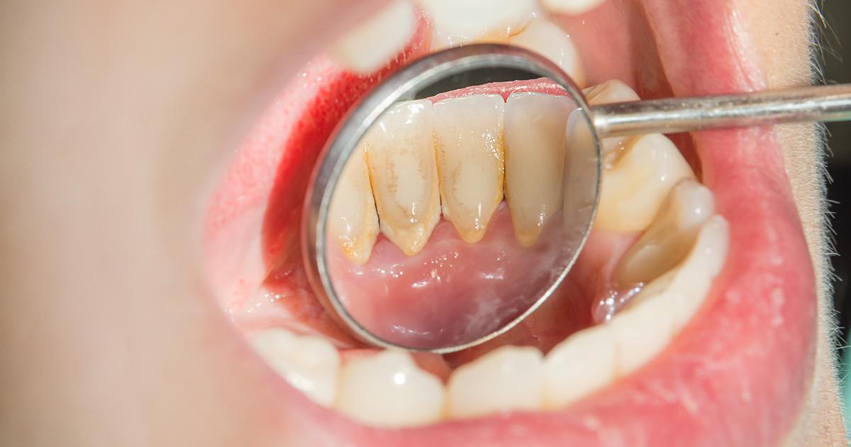 diferencias-placa-dental-sarro-social