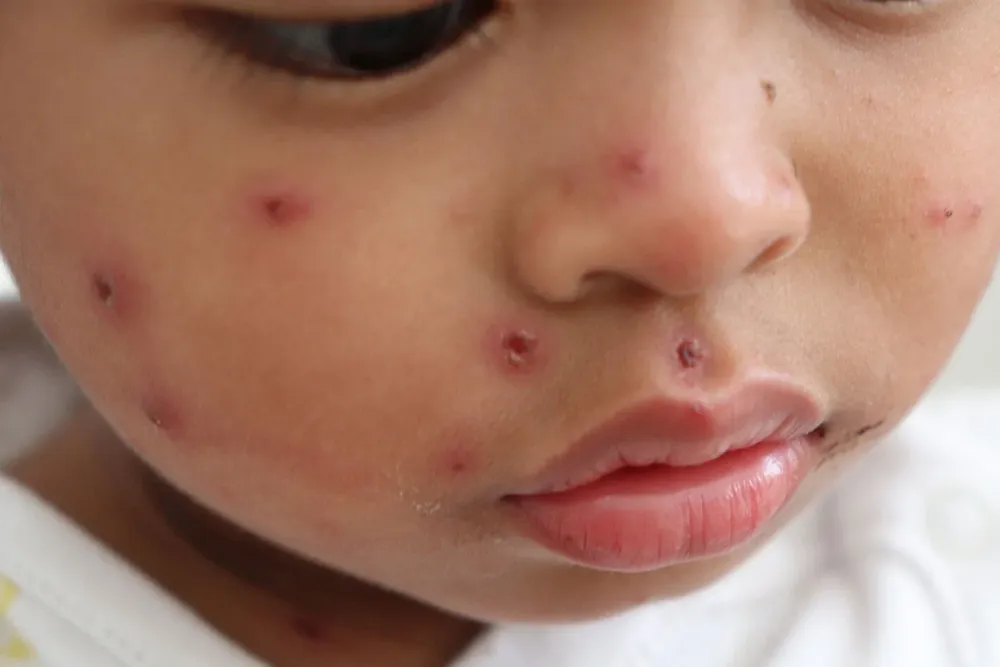 boy-measles