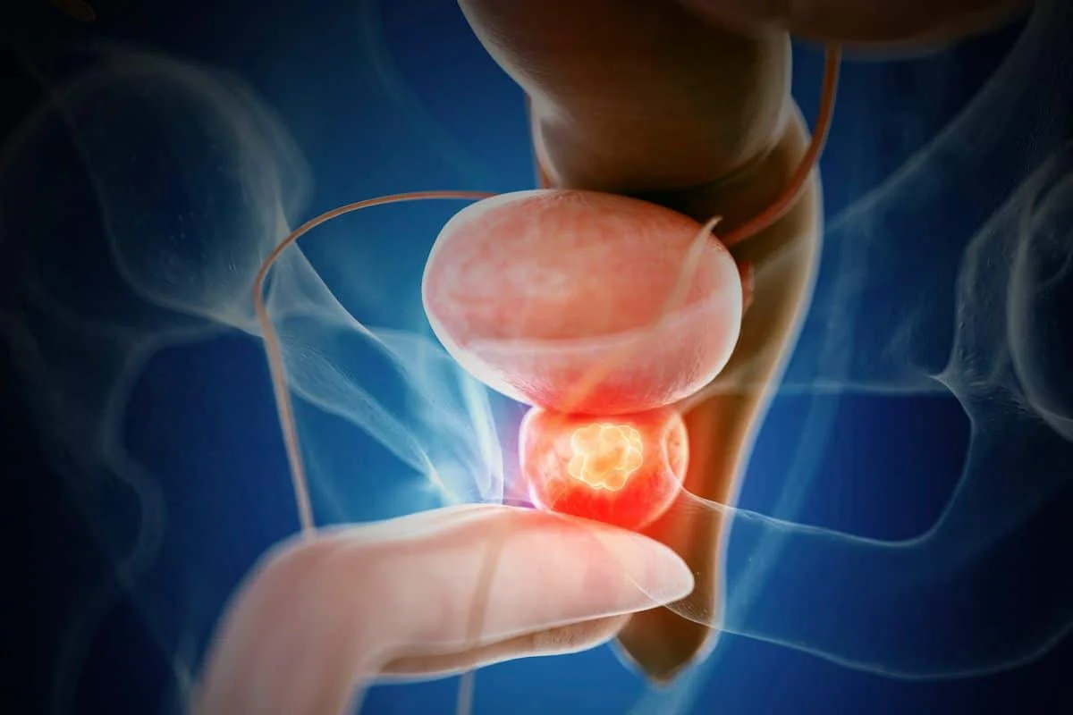 cáncer de próstata