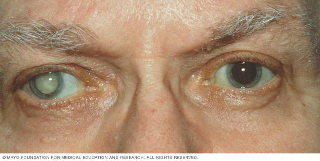 ds00050_im01228_vi7_cataractthu_jpg
